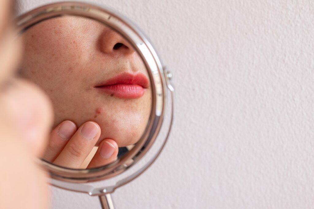 Close-up of a person looking at their chin with a pimple in a round handheld mirror against a plain wall.