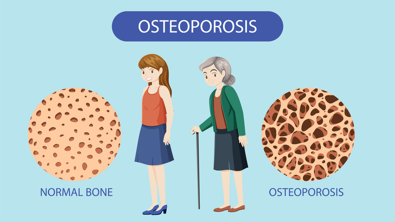Osteoporosis risk