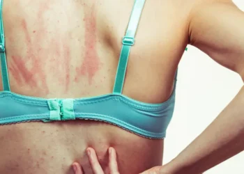 Atopic Dermatitis and Aging