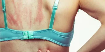 Atopic Dermatitis and Aging